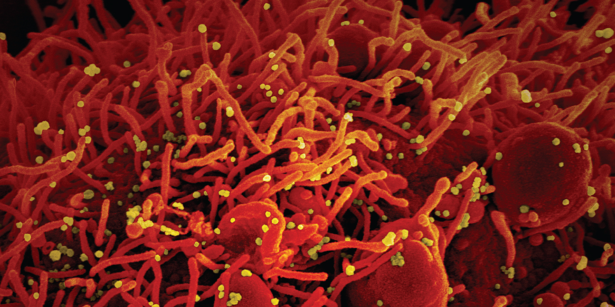 Colorized scanning electron microscope image of a cell infected with SARS-CoV-2