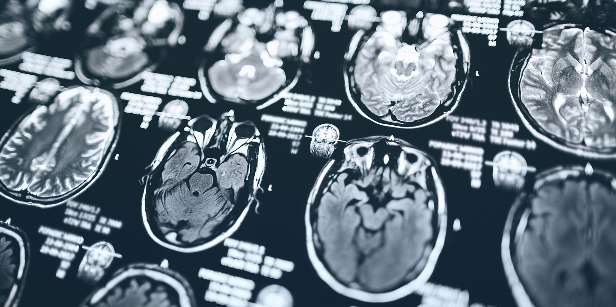 a series of MRI images of the brain