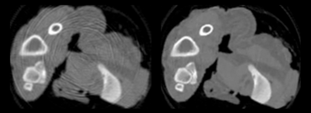 CT scan noise reduced by algorithm.